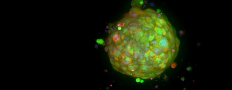 Patient-derived organoids (Tumoroids)