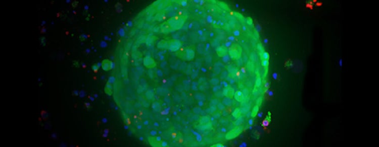 Breast Cancer Organoids