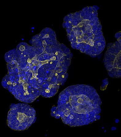 Colorectal tumor organoids