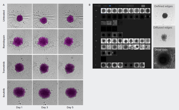 Morphometric Analysis on Patient-derived Spheroids Over Time