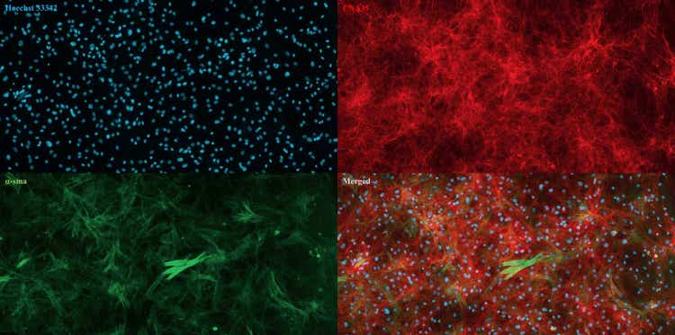 Images acquired using ImageXpress Pico System of cultured dermal fibroblasts isolated from cow skin. Nuclei (blue), collagen (red), alpha-smooth muscle actin (green)