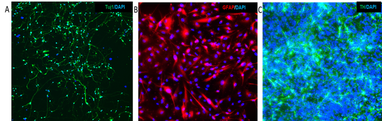 iPSCs-derived - Tuj1, GFAP and TH with Nuclei Counterstained with DAPI