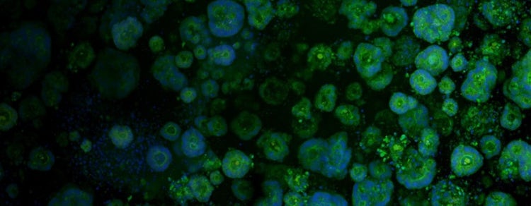 Patient derived Colorectal Cancer Organoids