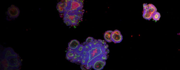 Cancer Organoids