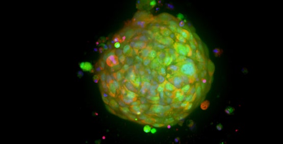Patient-derived organoids (Tumoroids)
