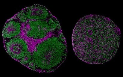 Patient-derived organoids in disease modeling